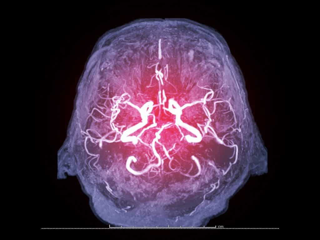 O Que é A Trombose Cerebral Conheça E Saiba Como Se Cuidar 3142